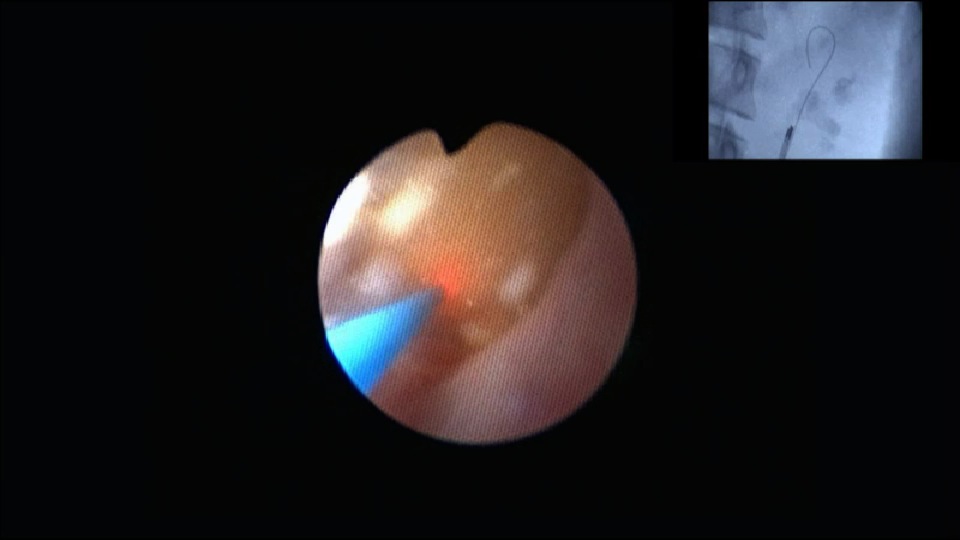 Ur&eacute;t&eacute;ror&eacute;noscopie souple chez l'enfant