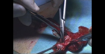 Tumorectomie testiculaire